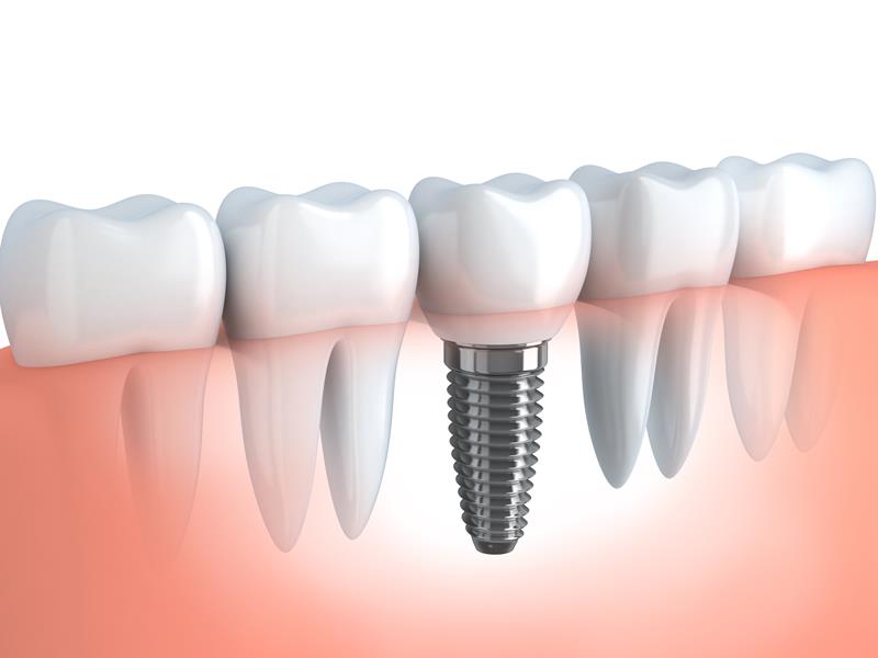 Dental Implants Mason, OH 
